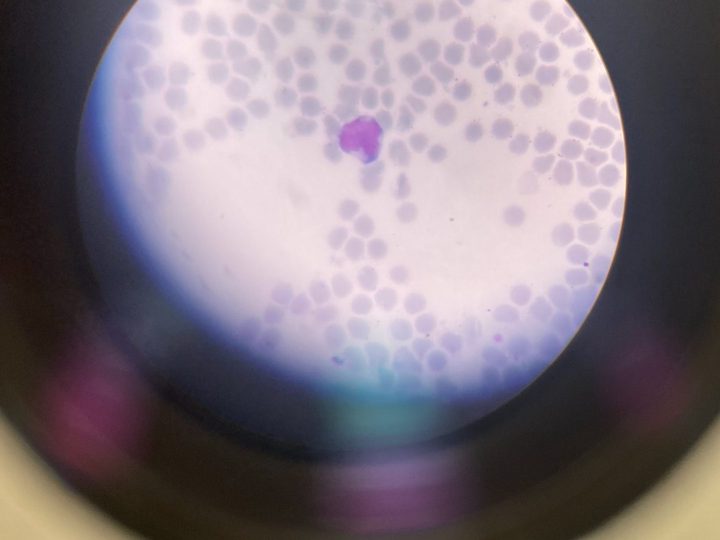 Blood smear: atypical mononuclear cell in a bright field of view