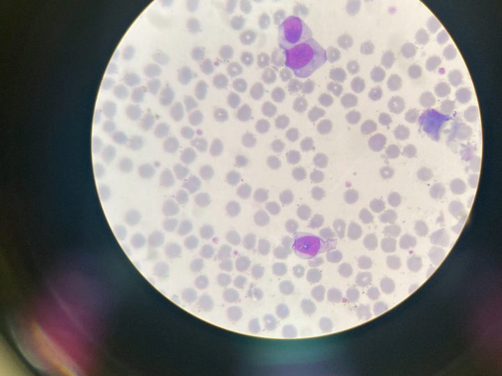 Blood smear: a pair of atypical broad-cytoplasm mononuclear cells