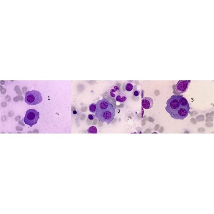 Bone marrow smear: atypical and multinucleated plasma cells in myeloma