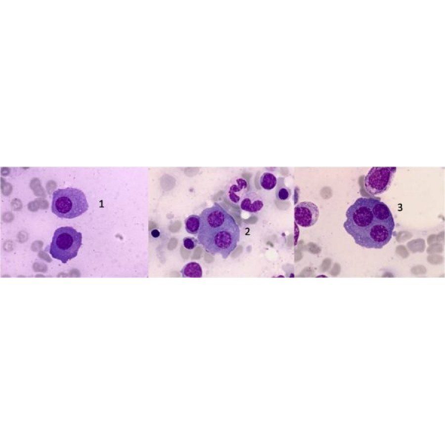 Atypical Plasma Cells in Multiple Myeloma: Morphology