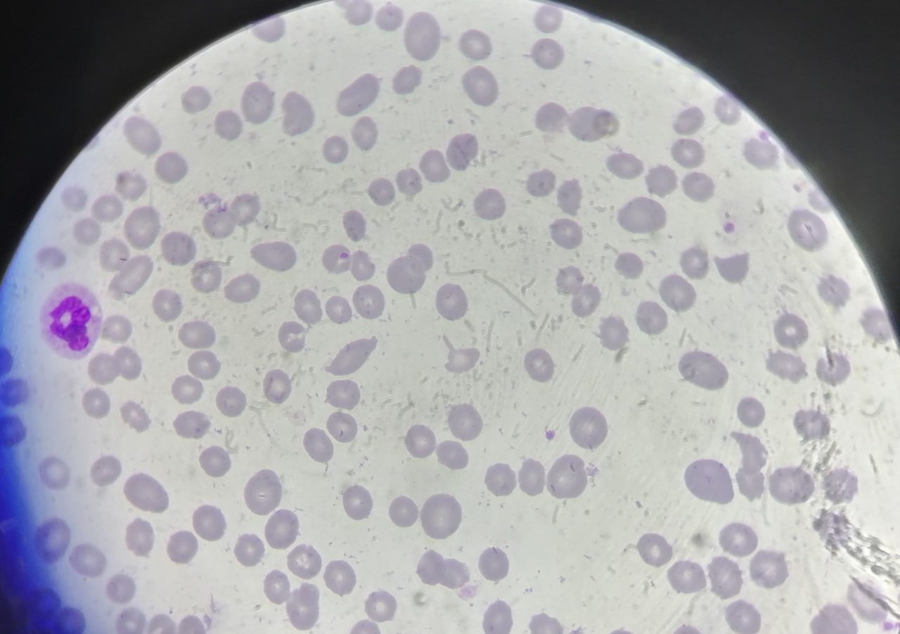 B12-Deficiency Anemia: Neutrophil Hypersegmentation