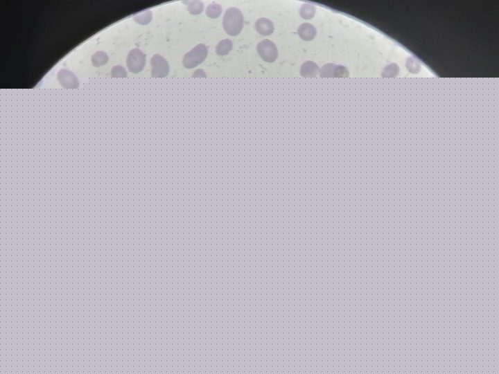 Blood smear: pronounced anisopoikilocytosis, schistocytes, and macrocytes