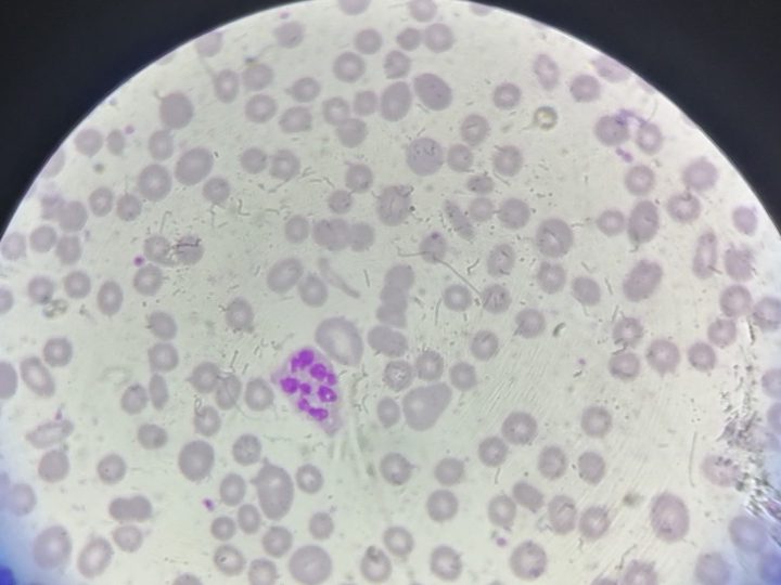 Blood smear: hypersegmented neutrophil against a background of poikilocytosis