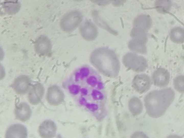 Blood smear: neutrophil with pronounced nuclear hypersegmentation