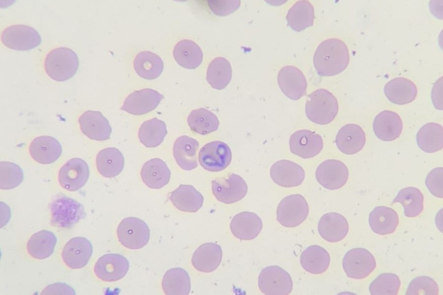 Babesiosis (Piroplasmosis): Detecting Babesia in Blood Smears