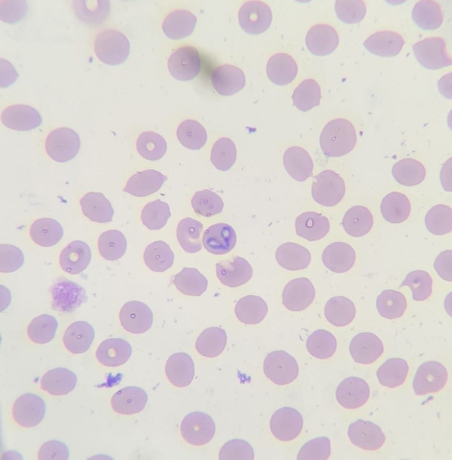Babesiosis (Piroplasmosis): Detecting Babesia in Blood Smears