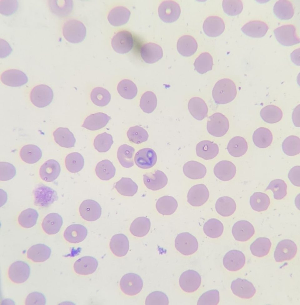 Blood smear, paired pear-shaped Babesia inside an erythrocyte