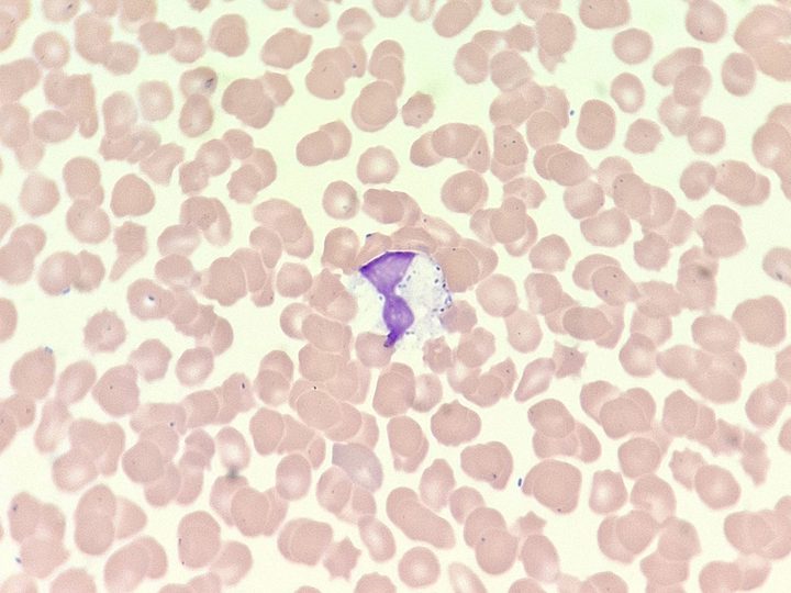 Мазок крови: деструктивные изменения лейкоцита и внутриклеточные бактерии