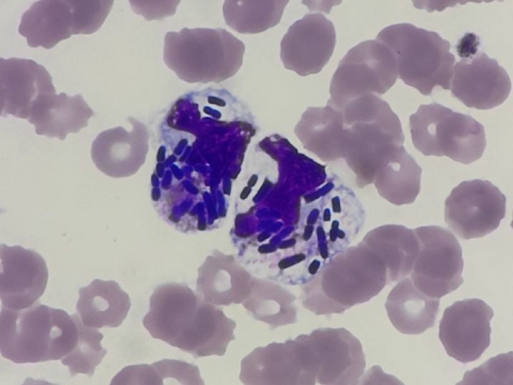 Мазок крови: нейтрофил с массивным фагоцитозом бактерий Klebsiella pneumoniae