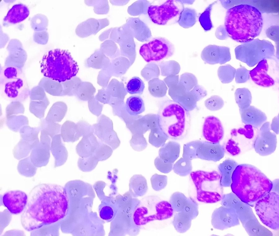 Basophil Morphology in Bone Marrow Aspirate