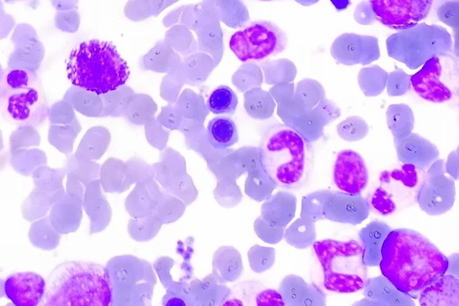 Basophil Morphology in Bone Marrow Aspirate