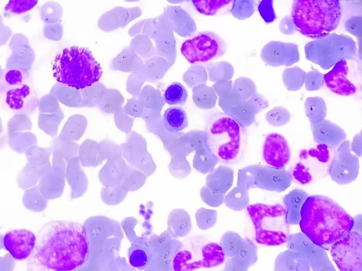 Bone marrow aspirate smear, mature basophil surrounded by myeloid cells