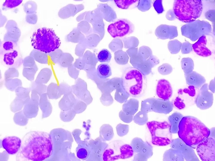 Bone marrow aspirate smear, arrow points to a granulocyte-basophil