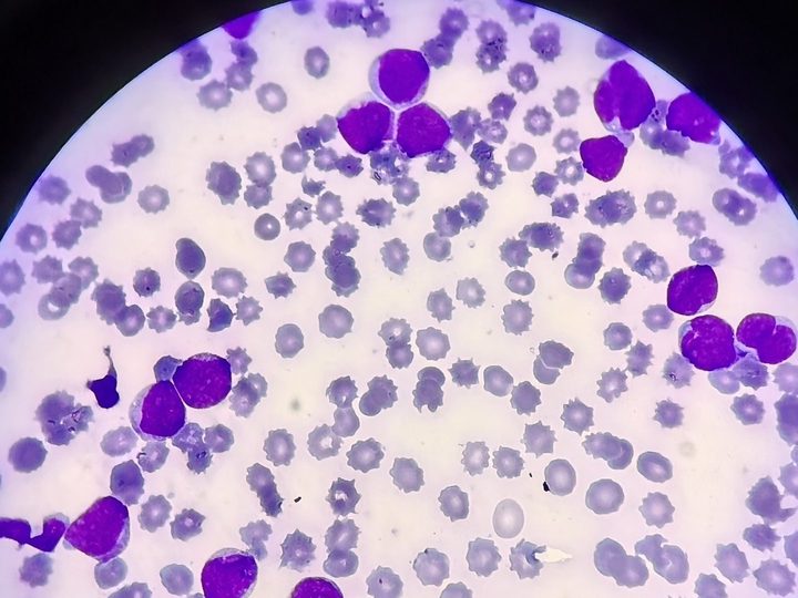 Мазок периферической крови: скопление бластов на фоне выраженной анемии