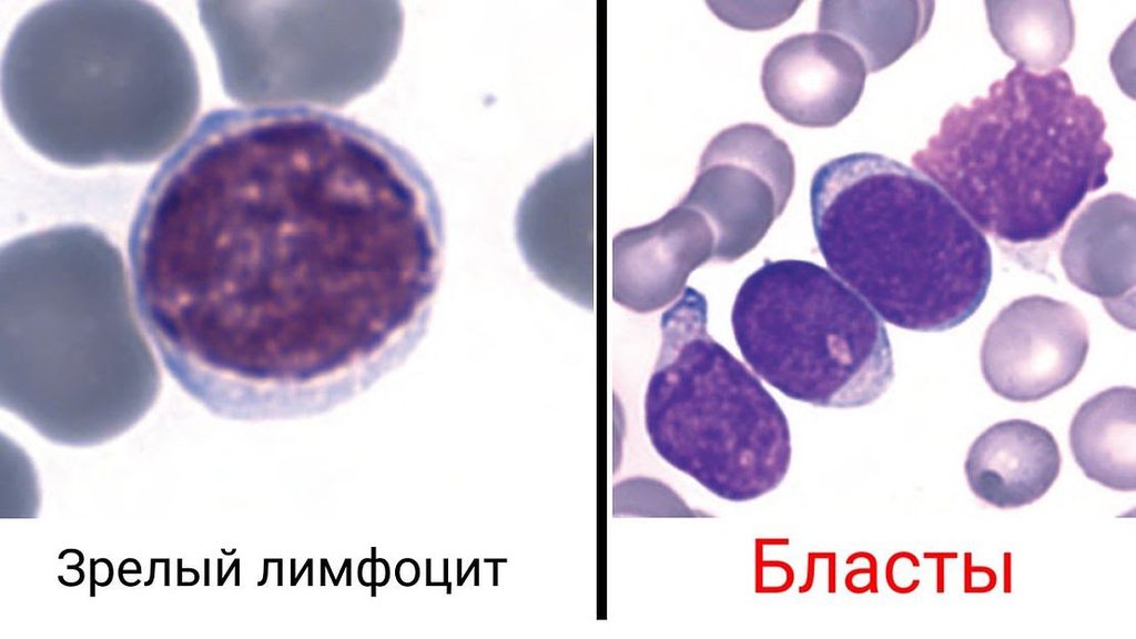 Морфология лимфоидных бластов в мазке периферической крови
