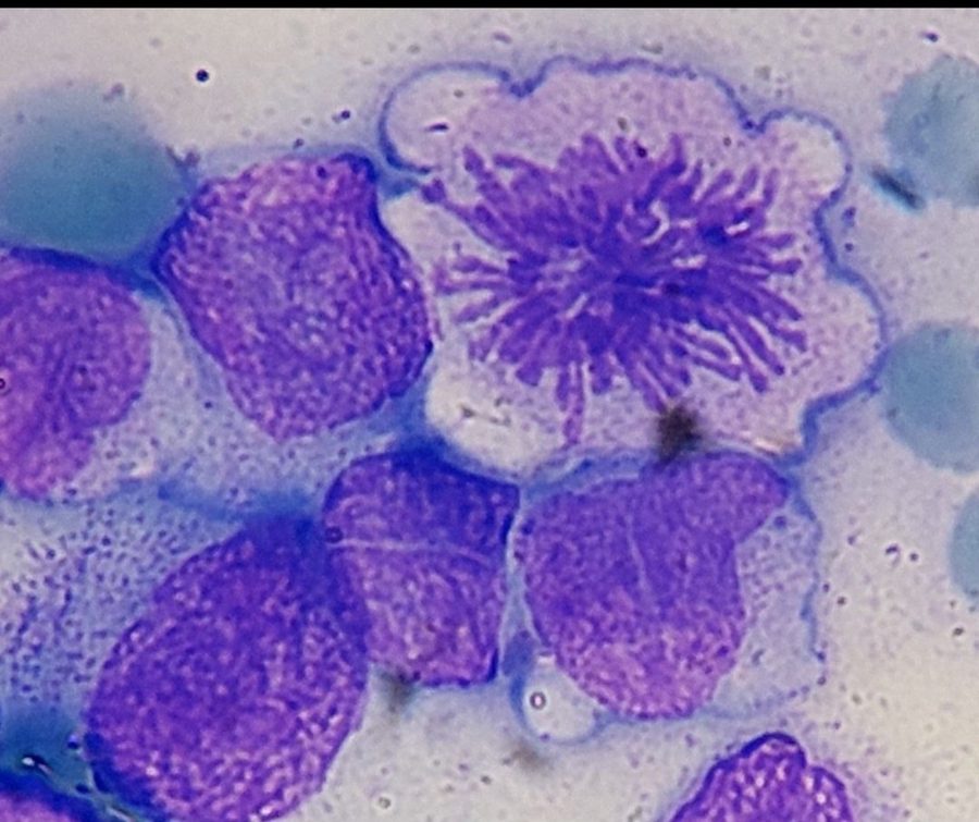 Blasts in Relapsed Acute Lymphoblastic Leukemia