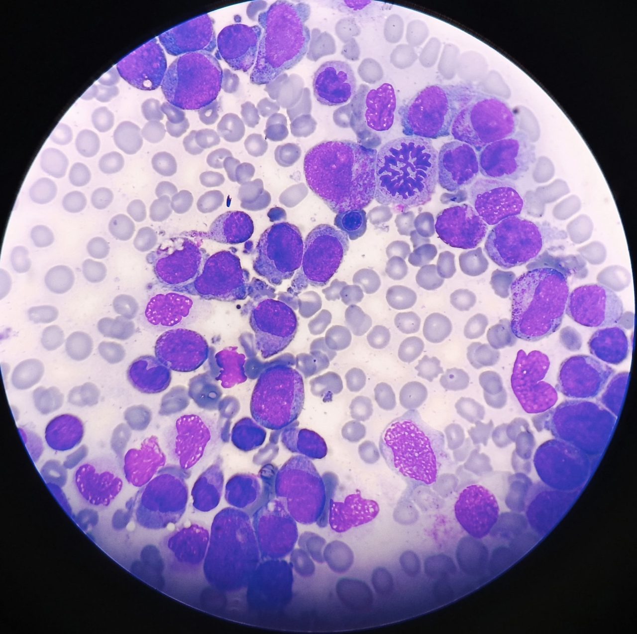 Blasts in Bone Marrow Aspirate in Acute Leukemia