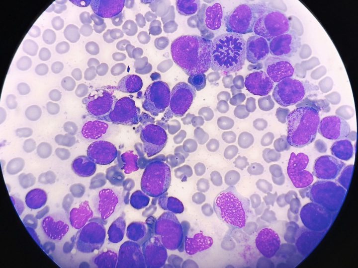 Bone marrow aspirate smear: blast infiltration and mitotic figure