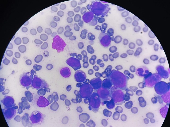 Bone marrow aspirate smear: cluster of blast cells with delicate chromatin