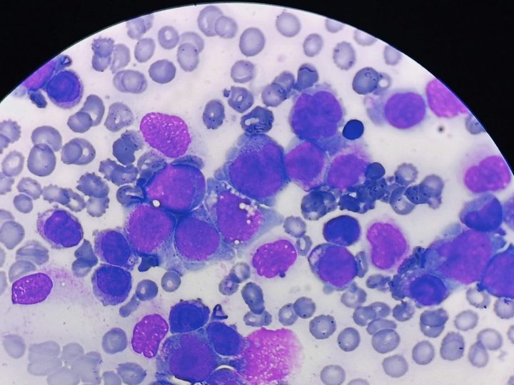 Bone marrow aspirate smear: atypical blasts with polymorphic nuclei and nucleoli