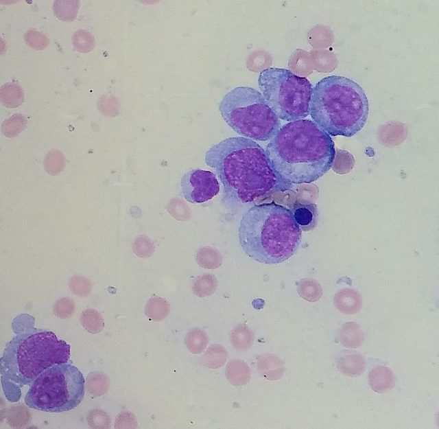 Bone Marrow Blasts in Acute Myeloid Leukemia: A Case Study