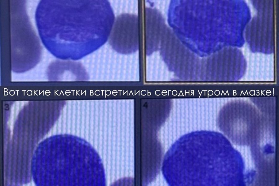 Бласты в мазке крови: дифференциальная диагностика