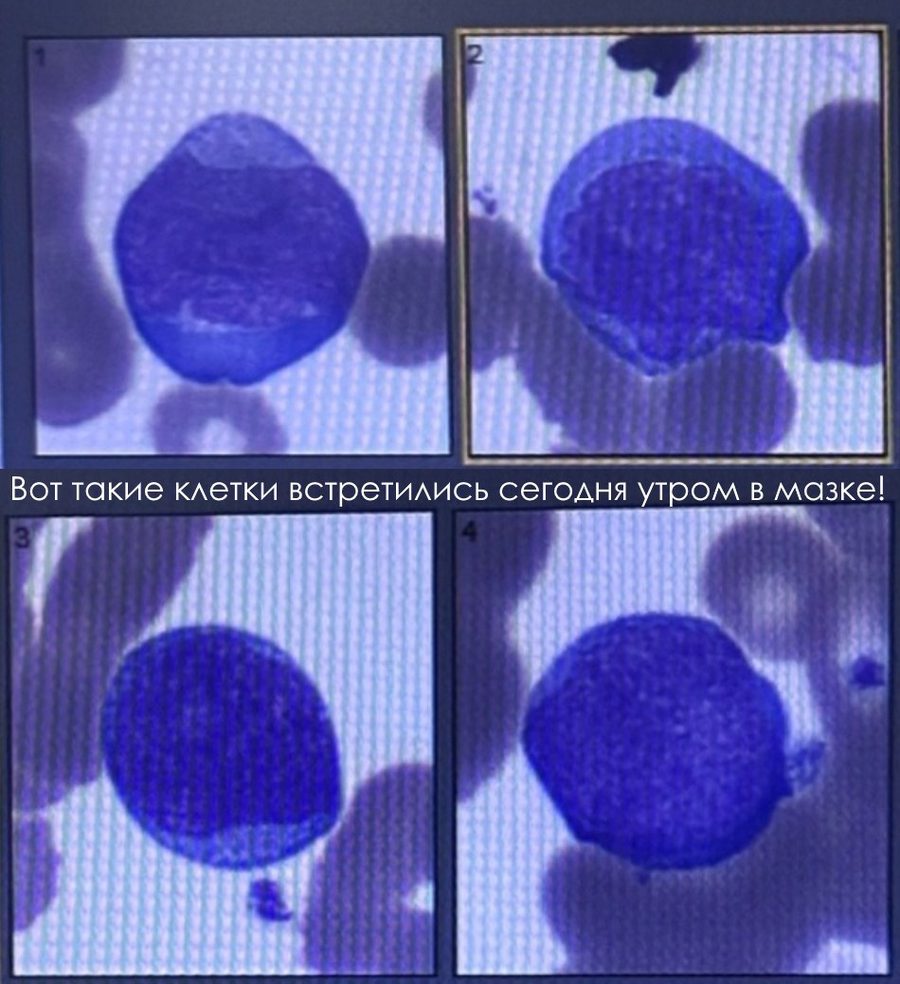 Бласты в мазке крови: дифференциальная диагностика