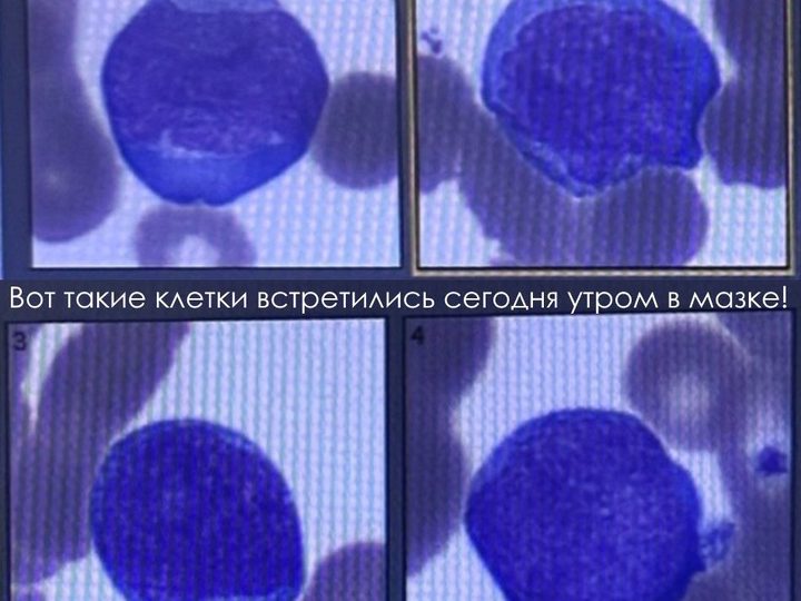 Цифровой мазок крови, атипичные мононуклеары, подозрительные на бласты