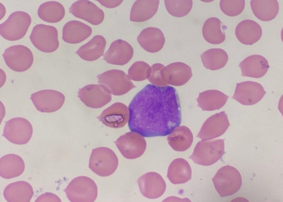 Blood smear, a single blast cell among erythrocytes