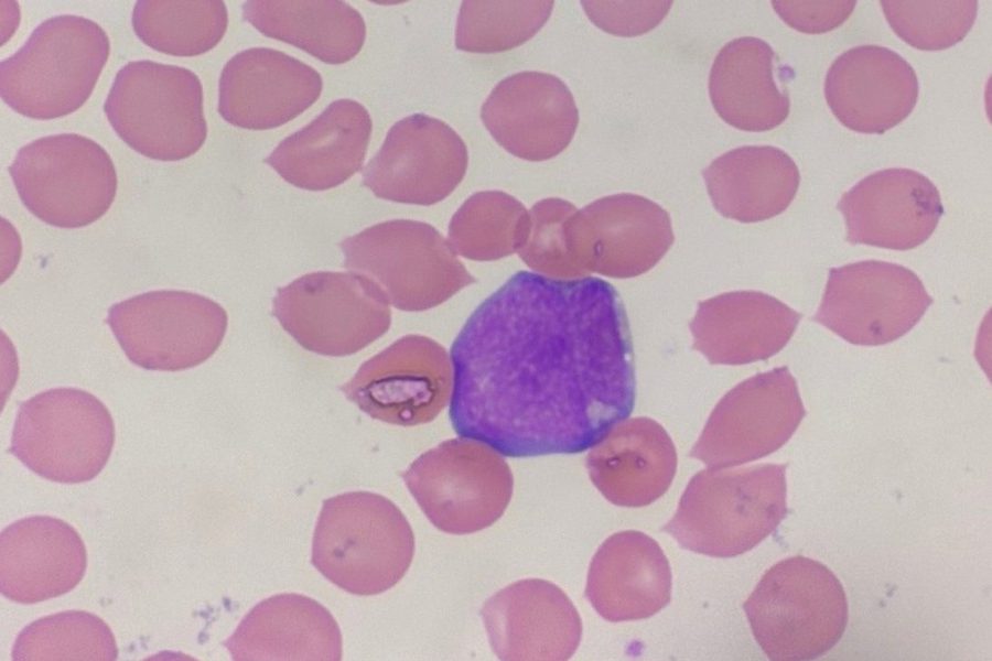 Blasts in Peripheral Blood Smear: Cell Morphology