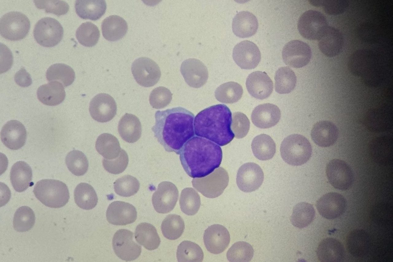 Blasts in Peripheral Blood Smear of an Adolescent