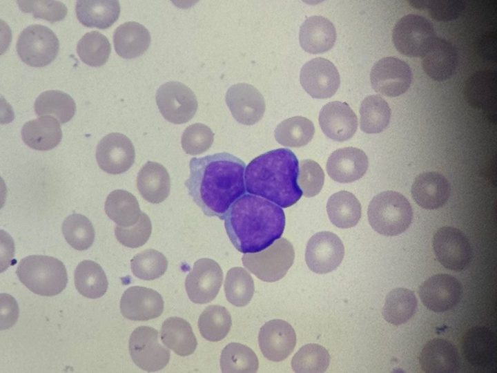 Blood smear, cluster of three blast cells with high N:C ratio