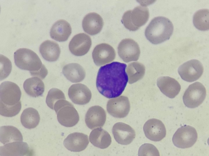 Blood smear, blast with a round nucleus and basophilic cytoplasm