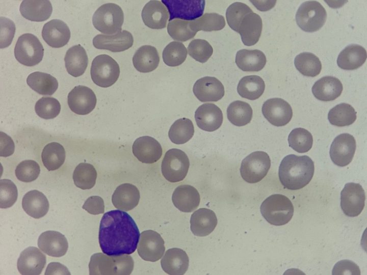 Blood smear, two blast cells with delicate nuclear chromatin