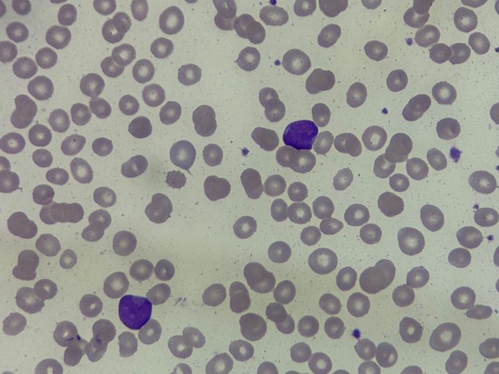Blood smear, overview field of view with several blast cells