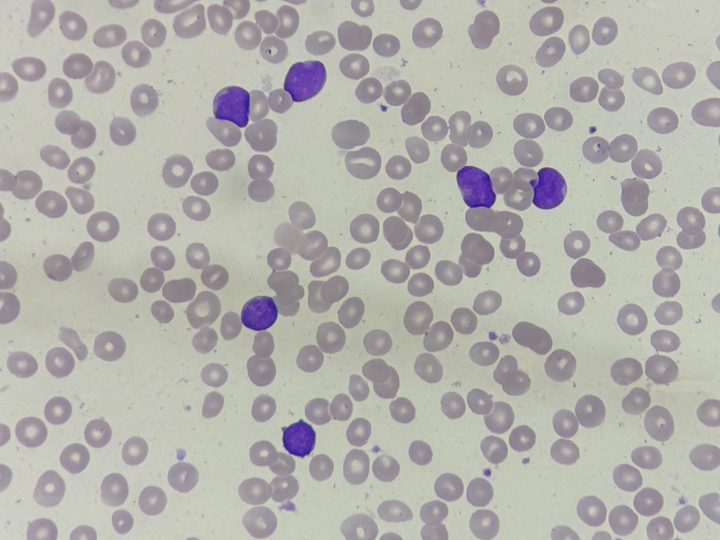 Blood smear, group of blasts against a background of erythrocyte anisocytosis