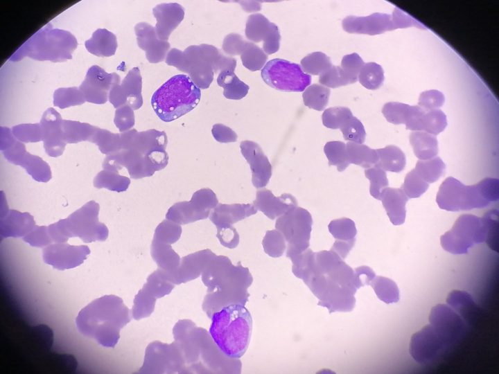 Мазок крови: бластные клетки с вакуолизацией цитоплазмы