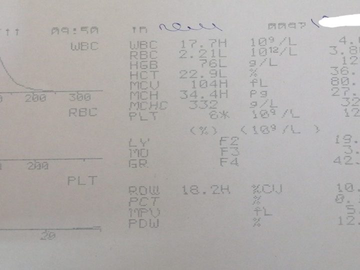 Распечатка анализатора: лейкоцитоз 17,7×10⁹/л и тромбоцитопения 8×10⁹/л
