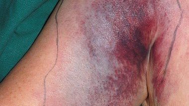 Из-за чего теряется кровь при заболевании печени