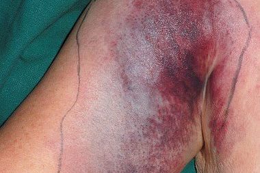 Из-за чего теряется кровь при заболевании печени