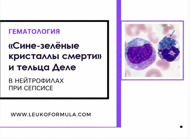 «Сине-зелёные кристаллы смерти» и тельца Деле в нейтрофилах