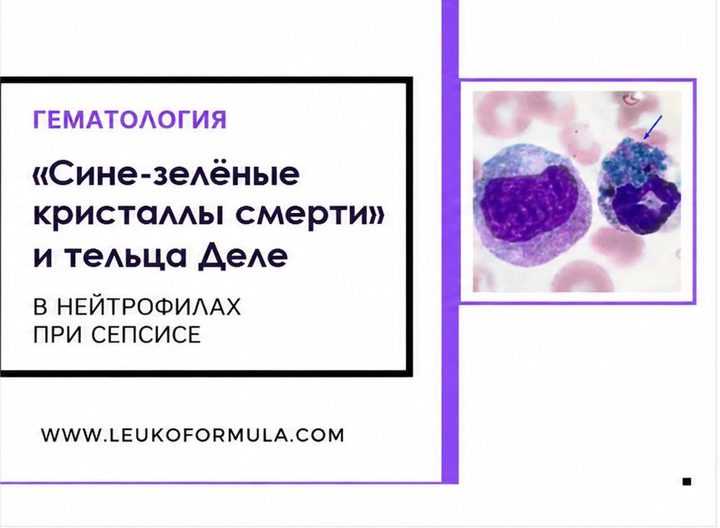 «Сине-зелёные кристаллы смерти» и тельца Деле в нейтрофилах