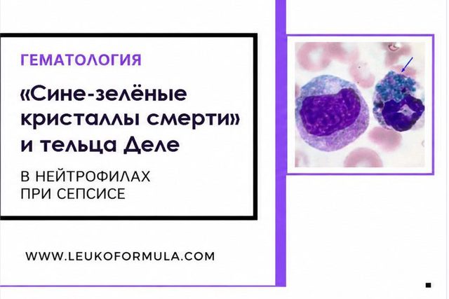 «Blue-green crystals of death» and Döhle bodies in neutrophils