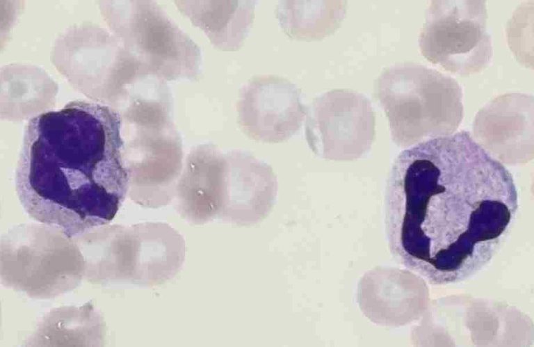 Blood smear of a woman in intensive care