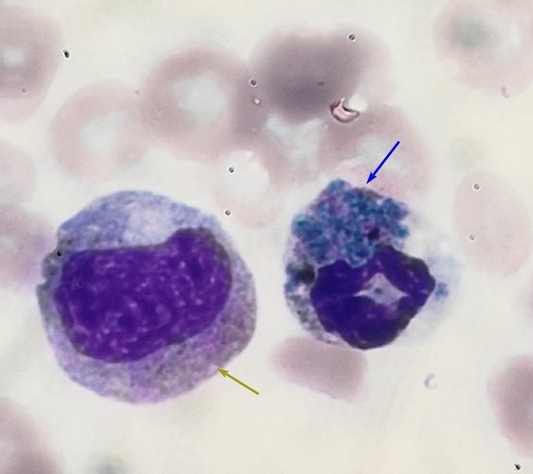 On the left a Döhle body in a white cell, on the right a critical blue-green inclusion in a neutrophil