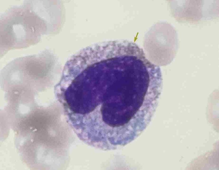 A Döhle body in a white cell