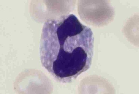 Döhle bodies in a segmented neutrophil