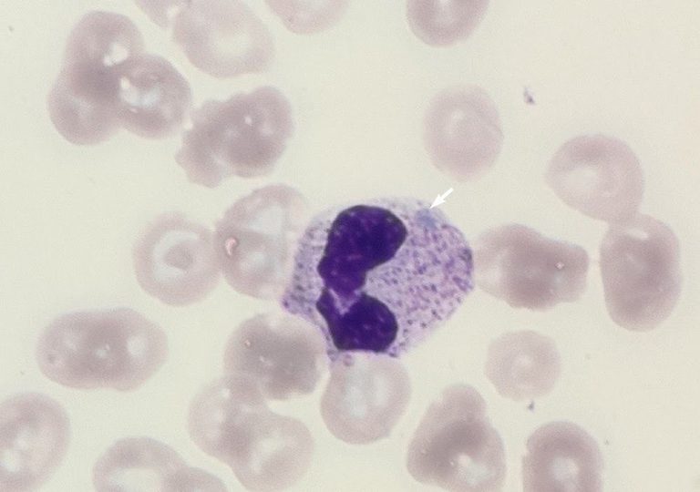 A Döhle body in a neutrophil of the woman with sepsis