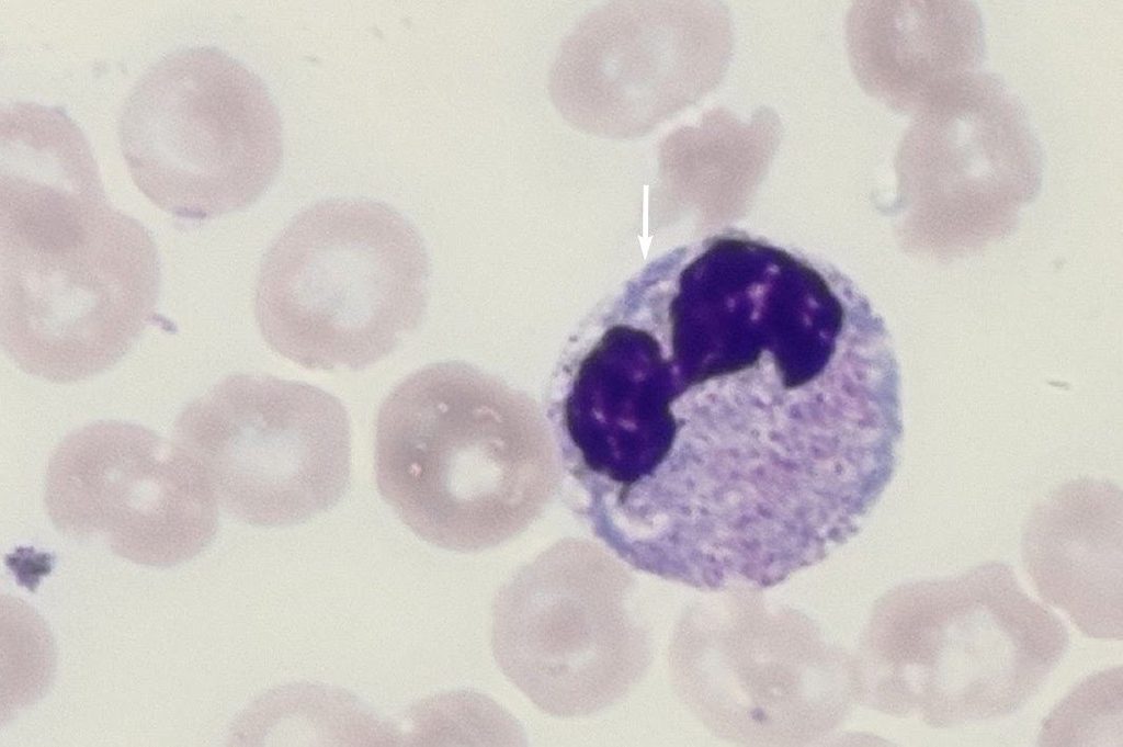 A Döhle body in a neutrophil of the 81-year-old woman from intensive care
