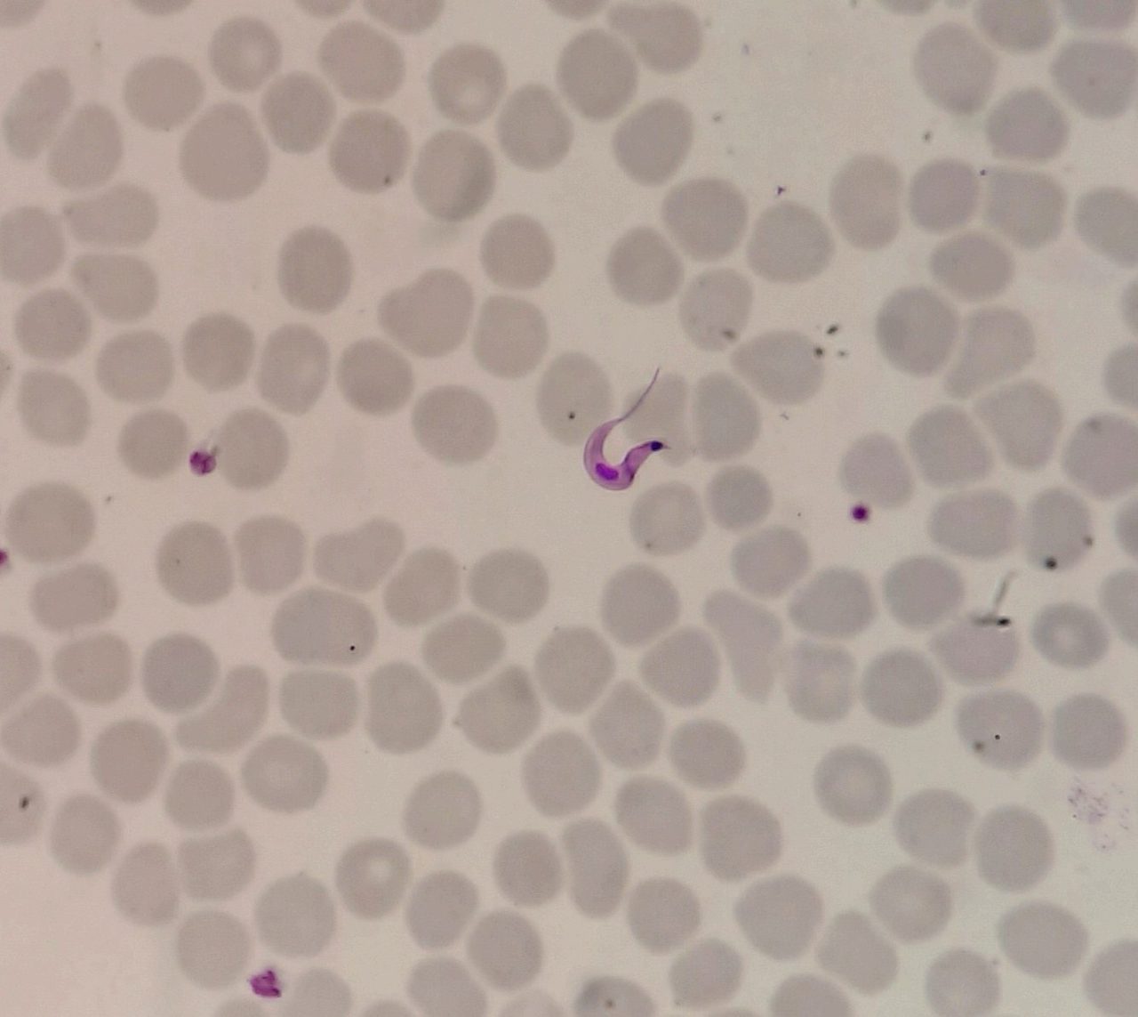Chagas Disease: Trypanosoma cruzi in a Blood Smear